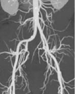 Arteriograficzny obraz tętnic w projekcji AP