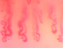 Kapilaroskopowy obraz pętli włosniczkowych