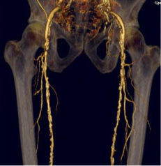Obraz zmiażdżycowanych tętnic kończyn dolnych w tomografii
