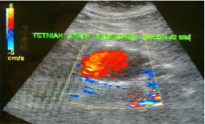 Tętniak aorty brzusznej w badaniu Kolor Doppler