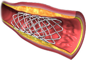 Stent wewnątrz tętnicy